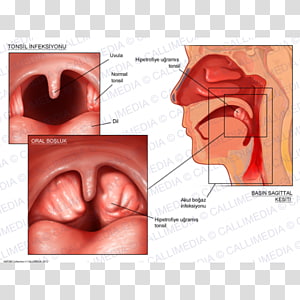 Pharynx Adenoid Epithelium Tonsil Histology Goblet Cell Carcinoid