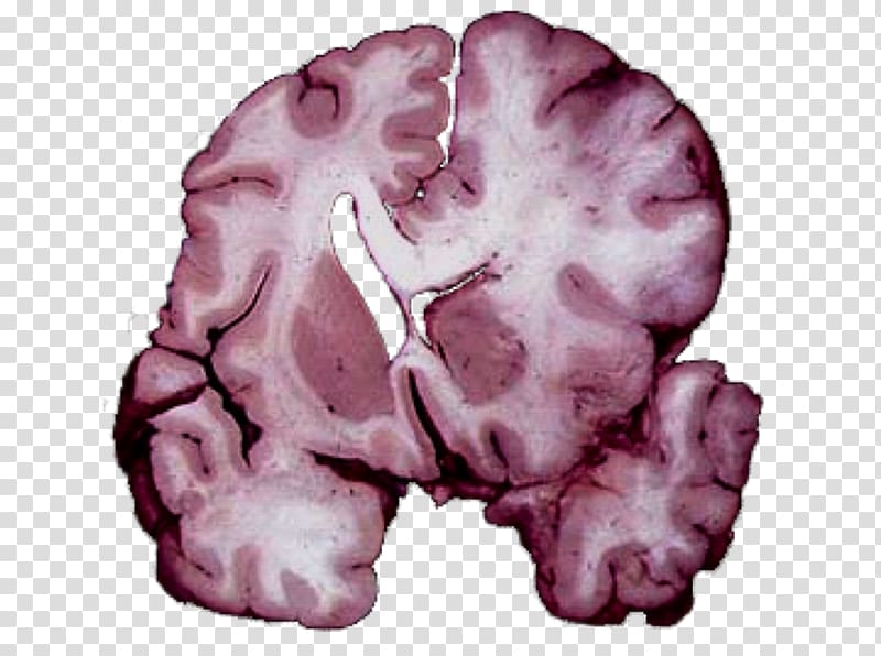 Brain herniation Intracranial pressure Traumatic brain injury Cerebellar tonsil, Brain transparent background PNG clipart