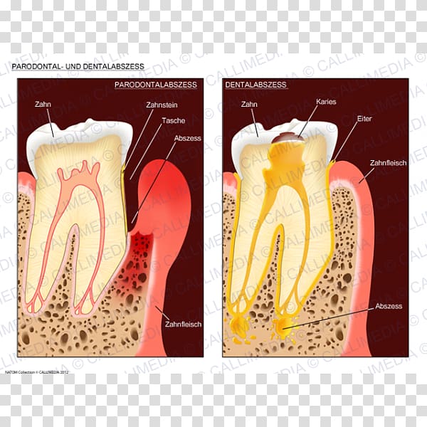Dental abscess Periodontal disease Periodontal abscess Gingivitis, carie transparent background PNG clipart