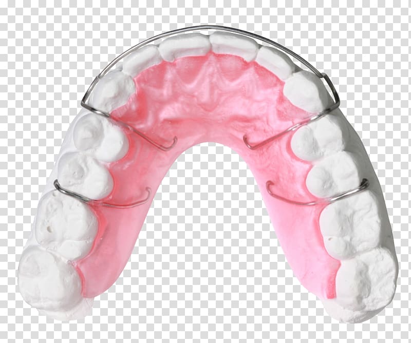 Orthodontics Orthodontic technology Jaw Quad helix Dentistry, others transparent background PNG clipart