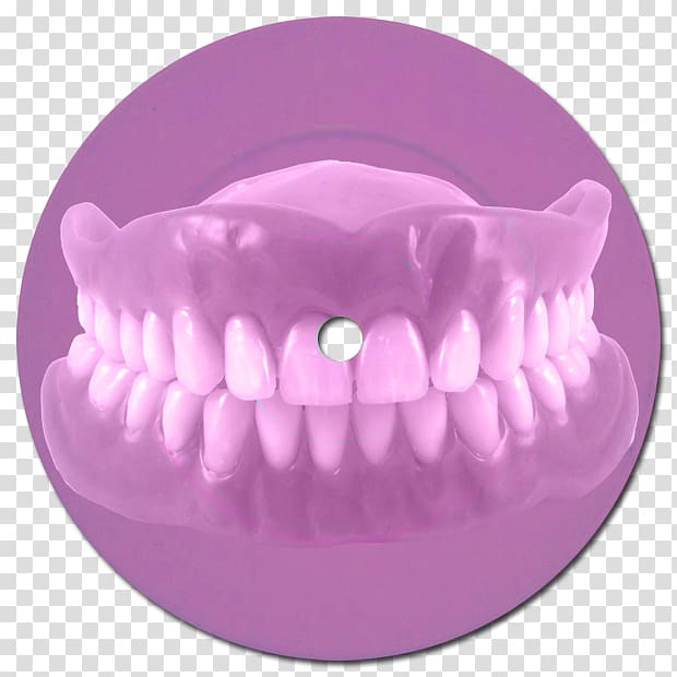 Dentures Dentistry Bridge Dental implant, bridge transparent background PNG clipart
