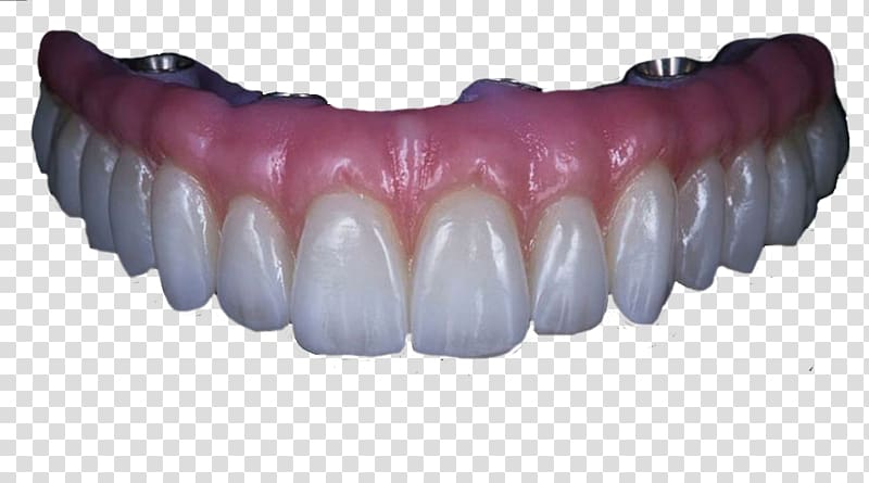 Human tooth Angelet de les dents Dentures Dental implant, crown transparent background PNG clipart