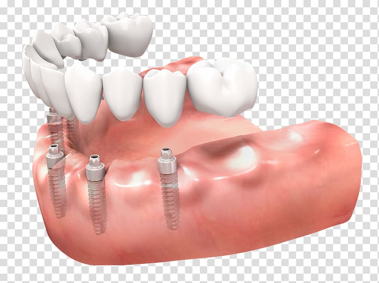 Tooth Dentures Dental implant Implantology, bridge transparent background PNG clipart