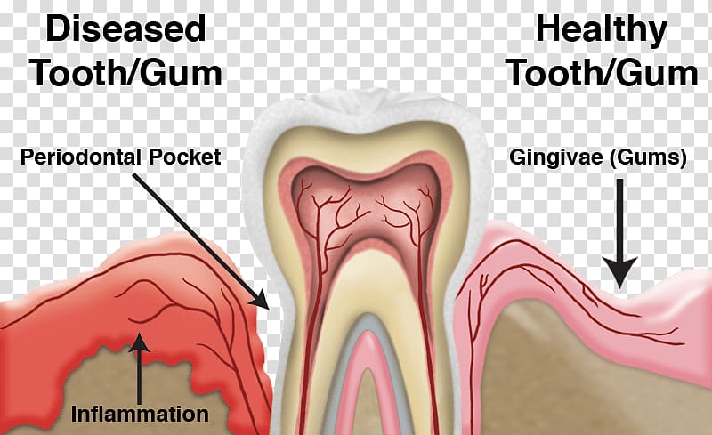 Tooth Periodontal disease Dentistry Gums, health transparent background PNG clipart