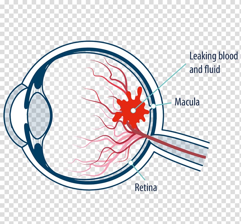 Macula of retina Macular edema Diabetic retinopathy Eye, Eye transparent background PNG clipart