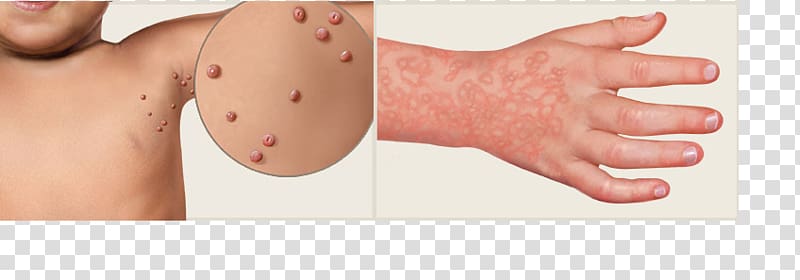 Exanthem Skin rash Virus Morbilliform Fifth disease, child transparent background PNG clipart