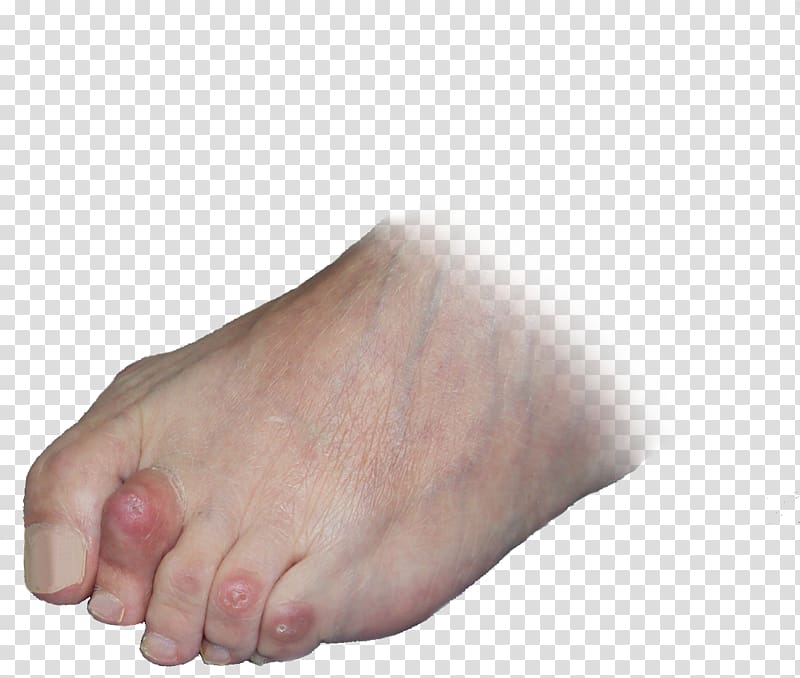Toe Digit Bent finger Foot, Wyroby Medyczne Refundowane transparent background PNG clipart