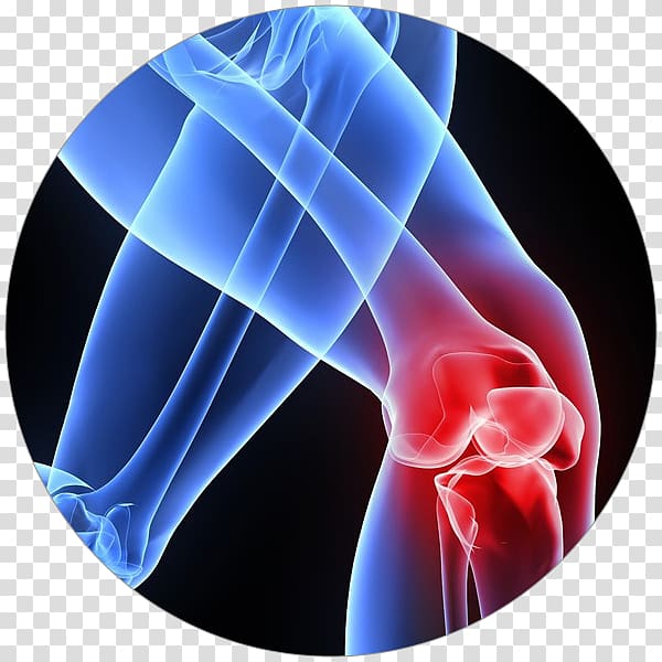 Patellar tendinitis Tendinopathy Knee pain, artrosis de rodilla transparent background PNG clipart