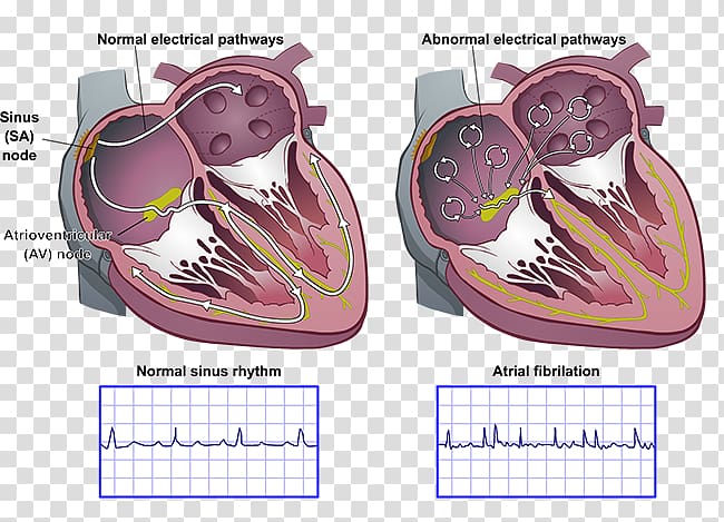 Heart arrhythmia AV nodal reentrant tachycardia Atrial fibrillation Sinoatrial node Atrium, heart transparent background PNG clipart