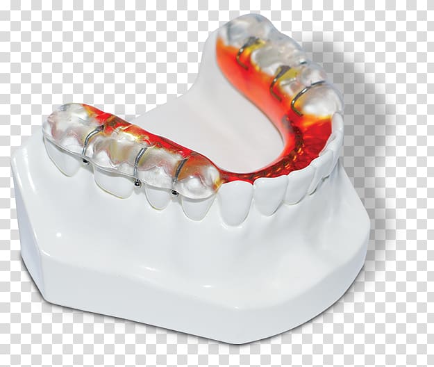 Mandible Jaw Tooth Maxilla Dentistry, mandibular advancement splints transparent background PNG clipart