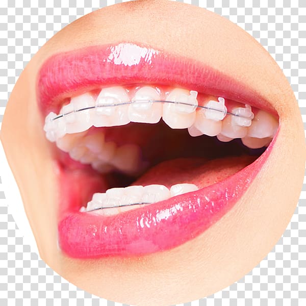 Byfleet Dental Boutique Orthodontics Dentistry Dental braces, others transparent background PNG clipart