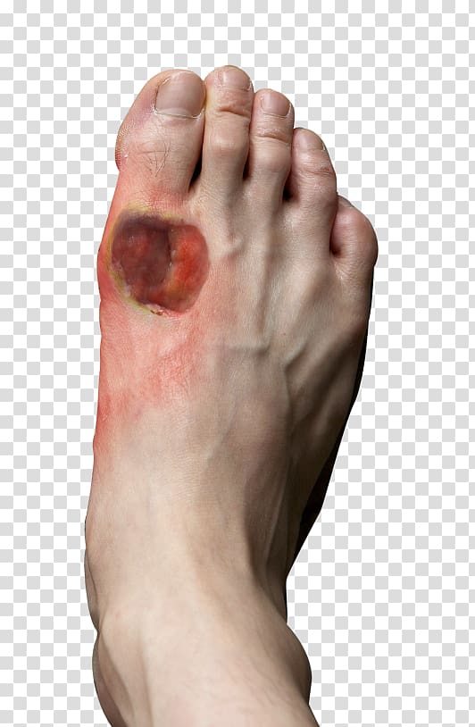 Diabetic foot ulcer Diabetes mellitus Athlete\'s foot, wounds transparent background PNG clipart