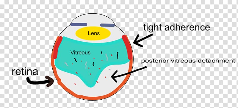 Posterior vitreous detachment Floater Vitreous body Retina psia, Eye transparent background PNG clipart