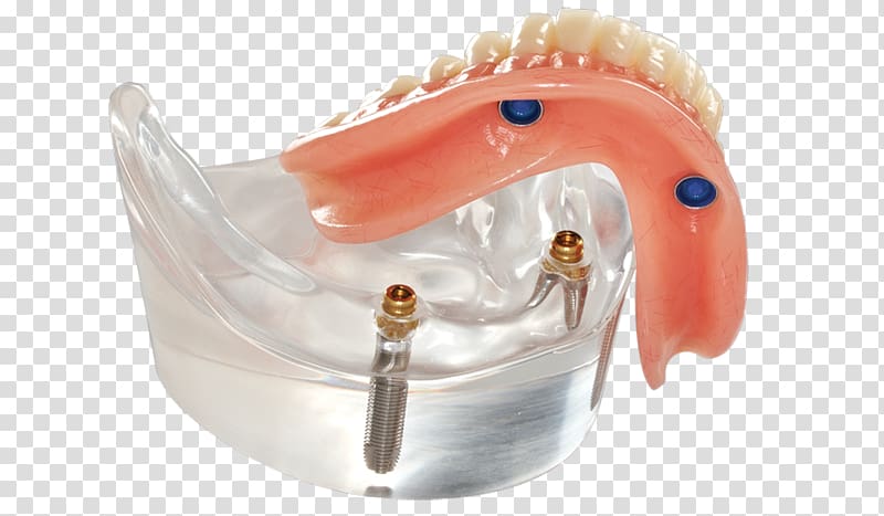 Dentures Dental implant Dentistry Removable partial denture All-on-4, bridge transparent background PNG clipart