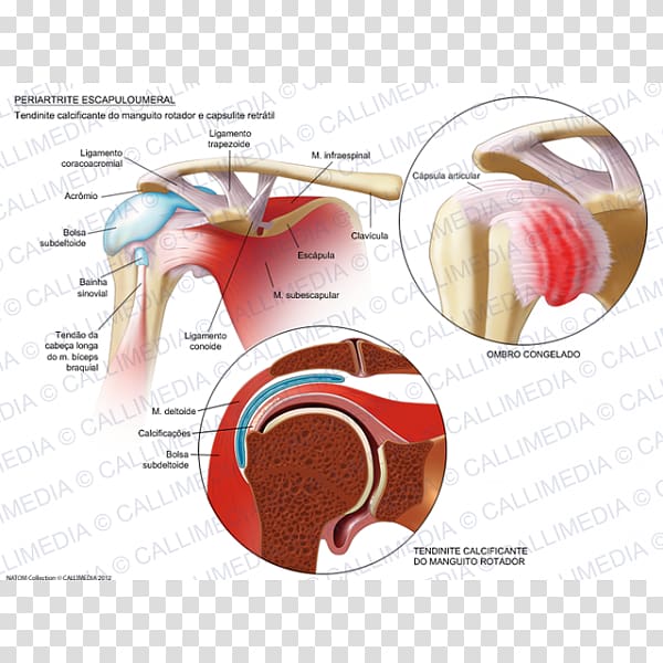 Adhesive capsulitis of shoulder Arthritis Periartrite scapolo-omerale Rheumatology Ache, scapula transparent background PNG clipart