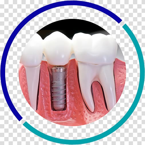 Dental implant Dentistry Tooth, bridge transparent background PNG clipart