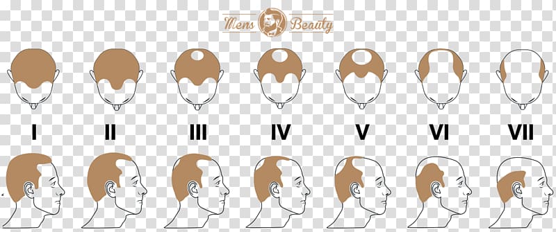Pattern hair loss Hair transplantation Hamilton–Norwood scale, hair transparent background PNG clipart