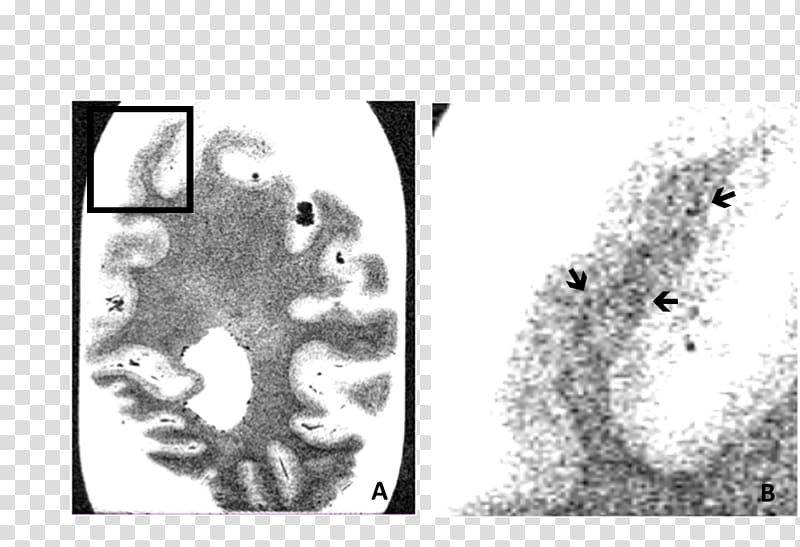 Occipital lobe Lobes of the brain Temporal lobe Cerebral cortex Parietal lobe, Alzheimer\'s Disease transparent background PNG clipart