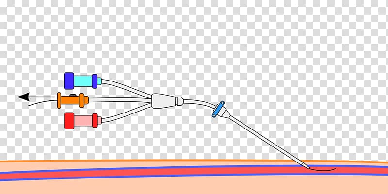 Seldinger technique Central venous catheter Peripheral venous catheter Trocar, catheter transparent background PNG clipart