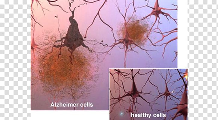 Alzheimer\'s disease Alzheimer\'s Association Brain Amyloid beta Senile plaques, Alzheimer\'s Disease transparent background PNG clipart