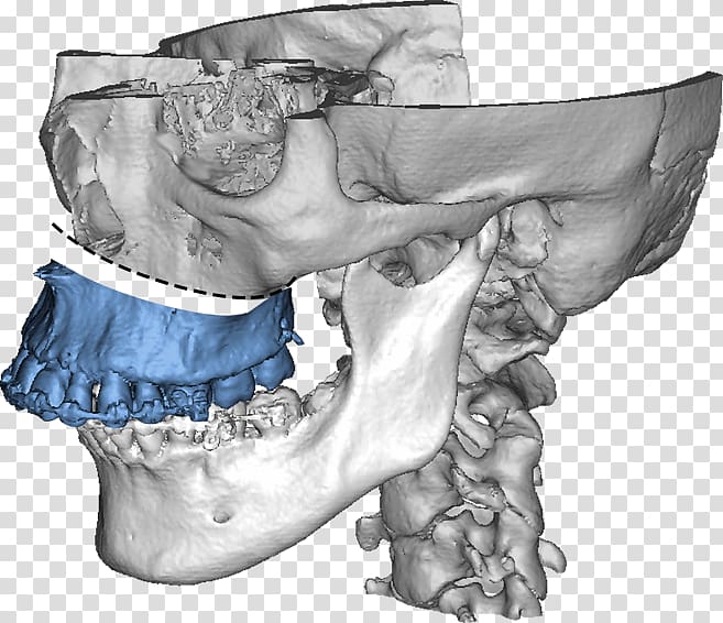 Maxilla Jaw Dysgnathie Bimaxillär Mandible, Head man transparent background PNG clipart