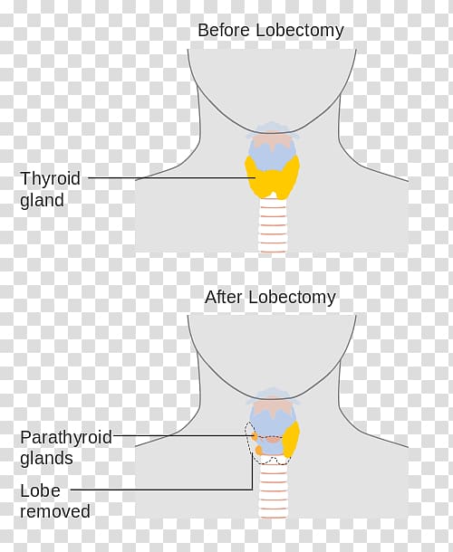 Thyroidectomy Lobectomy Surgery Thyroid cancer, thyroid transparent background PNG clipart