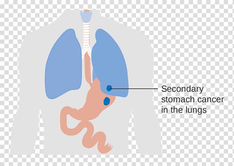 Stomach cancer Lung cancer, lung transparent background PNG clipart