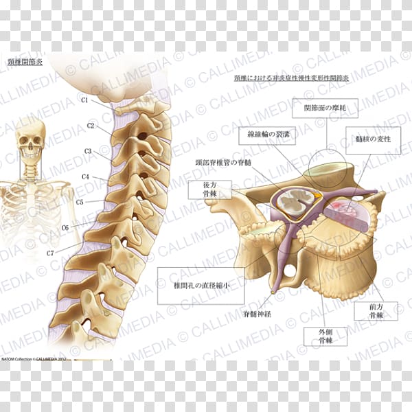 cervical osteoarthritis Cervical vertebrae Pain, Cervical Collar transparent background PNG clipart
