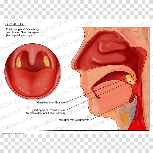 Tonsillitis Otorhinolaryngology Pharyngitis Oropharyngeal cancer, nose transparent background PNG clipart