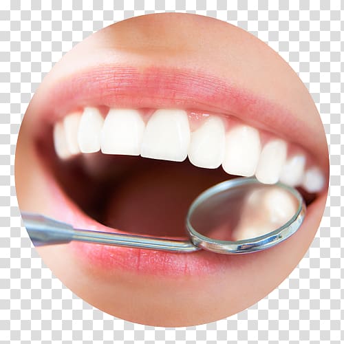 Dentistry Scaling and root planing Dental implant Teeth cleaning, health transparent background PNG clipart