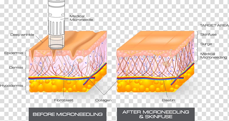 Collagen induction therapy Human skin Skin care, others transparent background PNG clipart