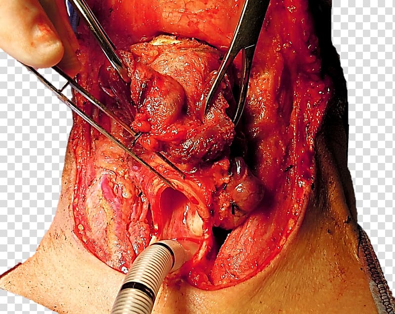 Laryngectomy Trachea Stoma Tracheotomy Glottis, trachea transparent background PNG clipart