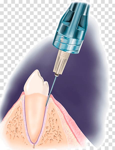 Dentistry Local anesthesia Dental anesthesia Local anesthetic, syringe transparent background PNG clipart