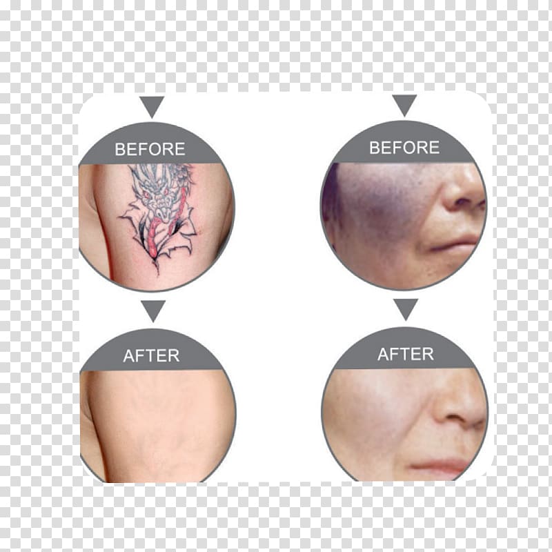 Nd:YAG laser Tattoo removal rejuvenation Laser hair removal, others transparent background PNG clipart