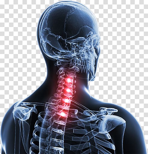 Spinal disc herniation Neck pain Vertebral column Thoracic vertebrae, Neck Pain transparent background PNG clipart