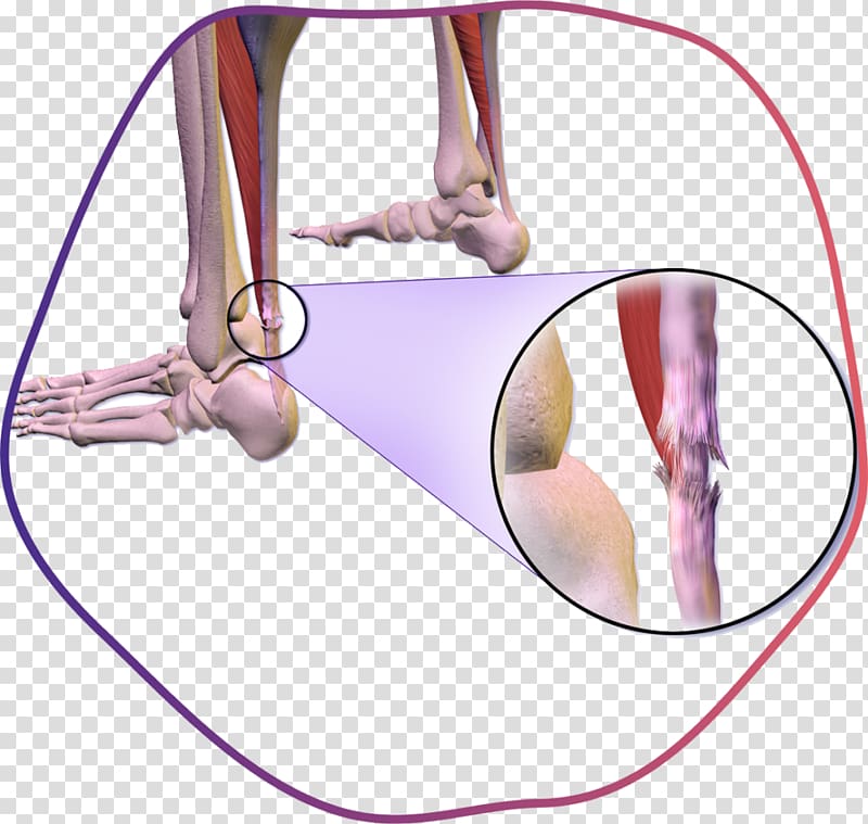 Achilles tendon rupture Achilles tendinitis, torn hamstring symptoms transparent background PNG clipart