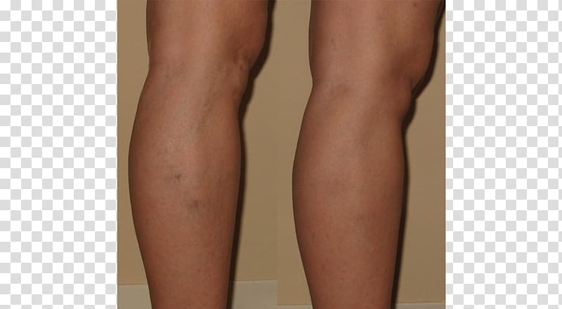 Thigh Active Undergarment Calf Knee Hip, Varicose Veins transparent ...