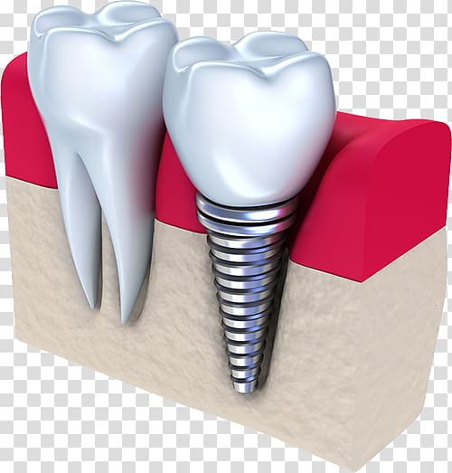 Dental implant Dentistry Tooth, crown transparent background PNG clipart