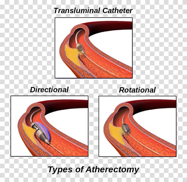 Atherectomy Peripheral artery disease Surgery Cleveland Clinic, Vascular Bypass transparent background PNG clipart