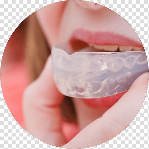 Mouthguard Bruxism Dentistry, Orthodontic correction transparent background PNG clipart