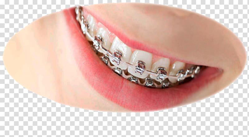 orthodontics Dental braces Dentistry, sugar skull transparent background PNG clipart
