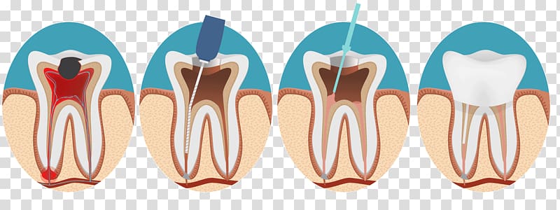tooth illustration collage, Endodontic therapy Root canal Endodontics Dentistry, dentistry transparent background PNG clipart
