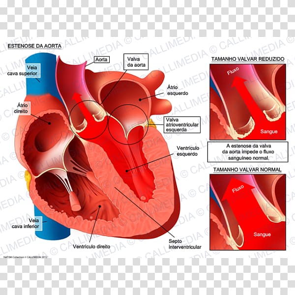 Mitral valve stenosis Mitral insufficiency Aorta Aortic insufficiency, heart transparent background PNG clipart