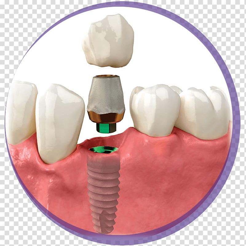 Tooth Dental implant Crown Zimmer Biomet, implant tooth transparent background PNG clipart