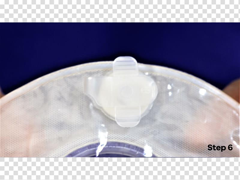 Stoma Colostomy Ostomy pouching system Laryngectomy United Kingdom, Bangkok Nurse Care Co Ltd transparent background PNG clipart