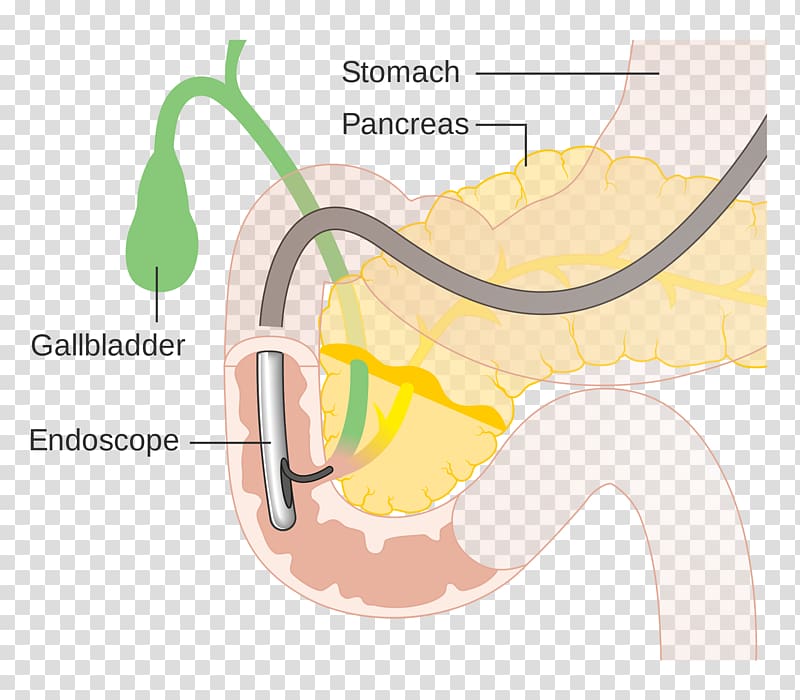 Endoscopic retrograde cholangiopancreatography Cholangiography Endoscopy Bile duct Medical procedure, abdominal pain transparent background PNG clipart