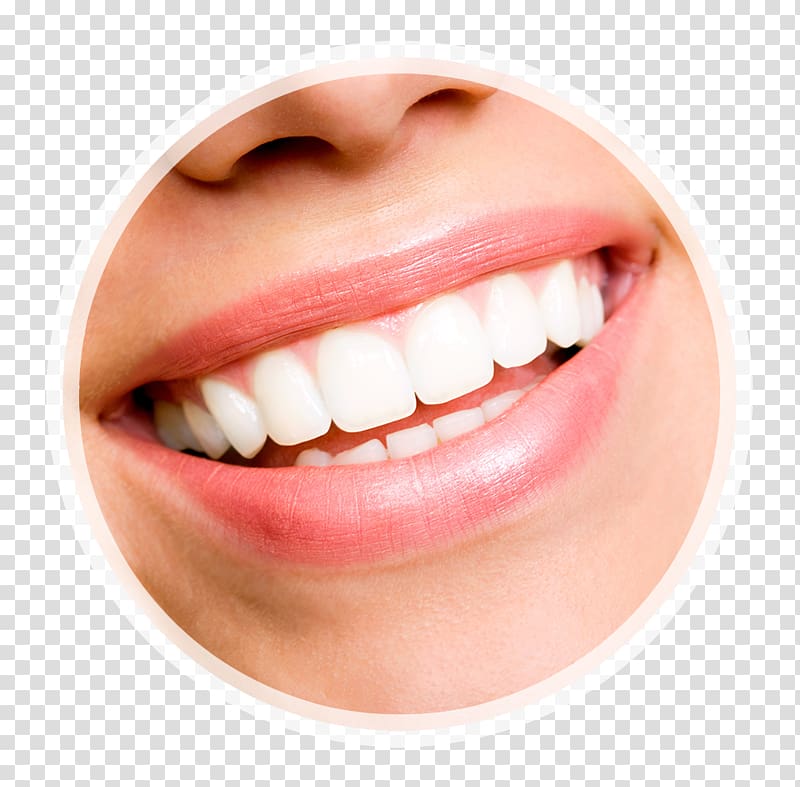 Veneer Tooth whitening Human tooth Dentistry, Coffee Stains Teeth transparent background PNG clipart
