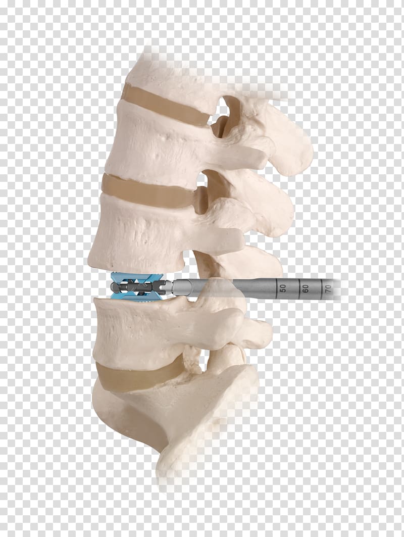 Spinal fusion Vertebral column Spinal decompression Human back Lumbar, others transparent background PNG clipart