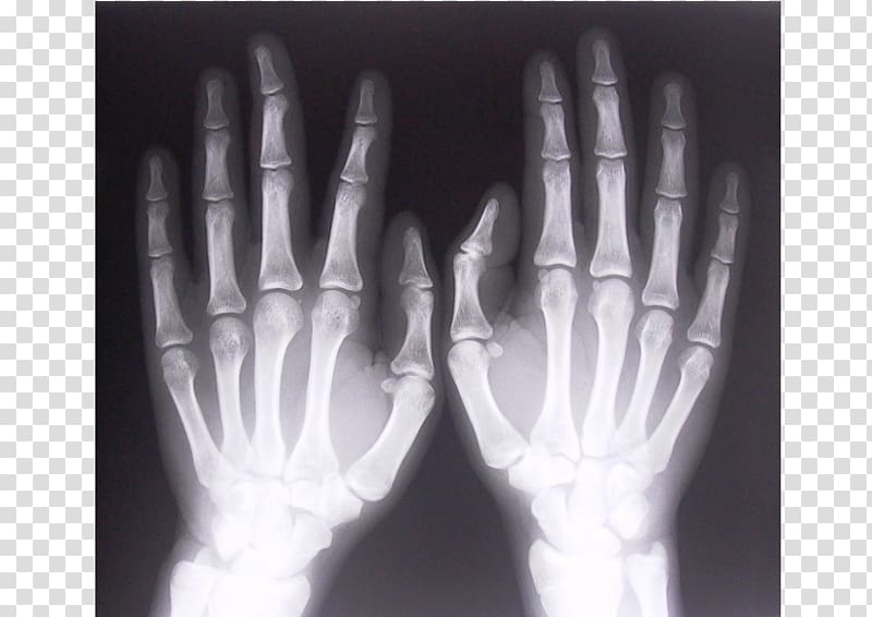 Backscatter X-ray Rheumatoid arthritis Joint, others transparent background PNG clipart
