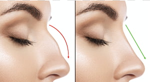 Nose Rhinoplasty Plastic surgery Surgeon, nose transparent background PNG clipart thumbnail